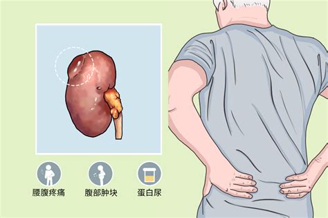 肾囊肿图片
