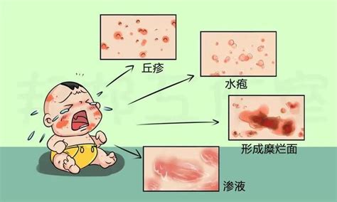 对于湿疹，中医讲究辩证论治，治疗上以疏风、清热、利湿为法。 - 知乎