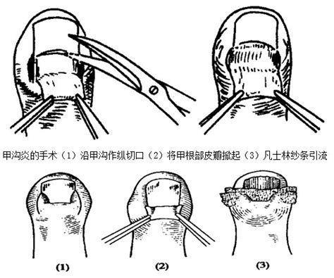 脓性指头炎图片