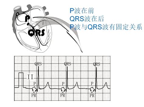 心律失常心电图分析，牢记两项“金规则”｜OCC 2021_心电图_刘霞_OCC2021_医脉通