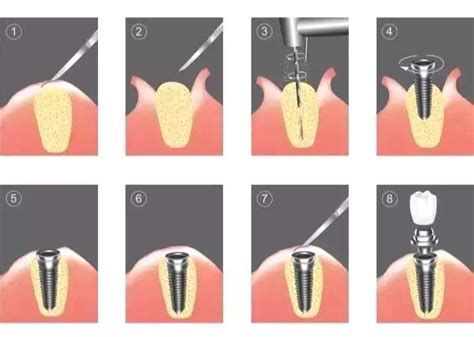 种植牙的过程是怎样-海南口腔医院【官网】