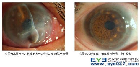 角膜溃疡图片