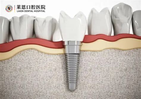 做种植牙手术过程详解-爱康健齿科