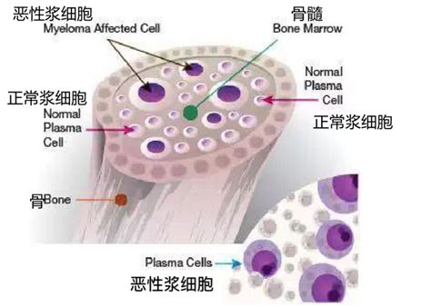 图233 骨髓增生异常综合征病态造血的粒系细胞-血液学细胞学-医学