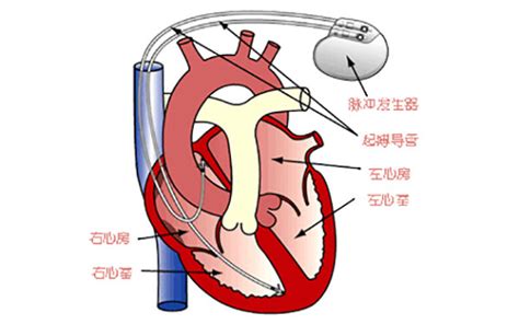 心脏起搏器 - 医学百科
