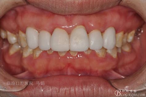 一例前牙氧化锆全瓷单冠-王坤的博客-KQ88口腔博客