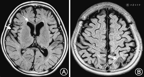 帕金森病和帕金森综合征的影像-INC国际神经外科医生集团