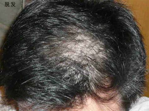 脱发的诱发因素具体有哪些_脱发_北京京城皮肤医院(北京医保定点机构)
