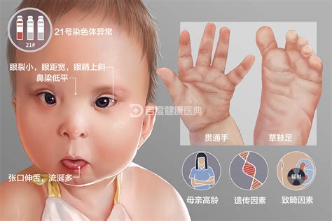 患有“唐氏综合征”的宝宝，面部特征很明显，婴儿阶段就能看出来_父母