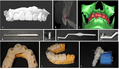 数字化导板引导技术辅助微创治疗前牙钙化根管