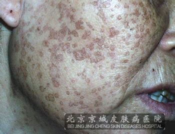 汗孔角化症图片