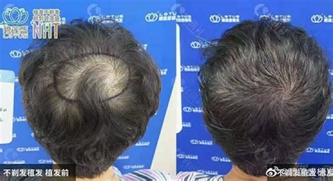 头发稀疏怎么恢复（如何留住日渐稀少的头发？） | 说明书网