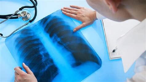 闭锁肺综合征的治疗方法-复禾疾病百科
