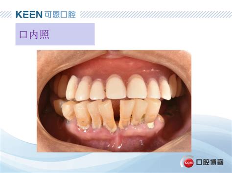 种植后覆盖义齿-李兴泉的博客-KQ88口腔博客