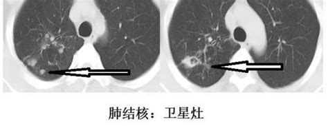 CT诊断肺结核宝典：这是我见过最好的经验总结_澎湃号·湃客_澎湃新闻-The Paper