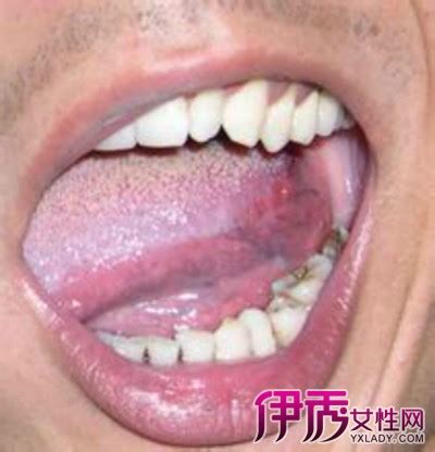 口腔上颚溃疡图片