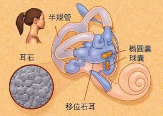耳石症图片
