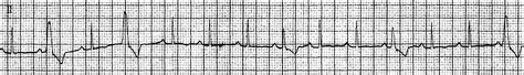 第141例 并行心律性室性心动过速-心律失常心电图分析-医学