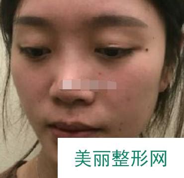 【多图】北京中日友好医院隆鼻多少钱？案例果图及医生列表_美嘉整形网(美学知识)