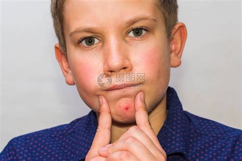 一个十几岁的男孩脸上的疙瘩青高清图片下载-正版图片506180089-摄图网