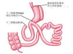 腹腔镜胃折叠术联合十二指肠空肠Omega转位术在修正可调节胃绑带术中的应用价值 - 中华消化外科杂志