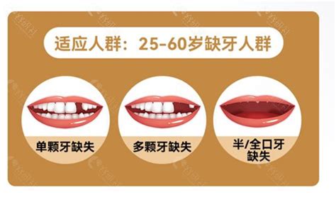 韩国种植牙价格表：登腾/奥齿泰/仕诺康/DIO种植体价格都有 - 爱美容研社