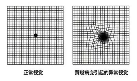 黄斑自测图图片