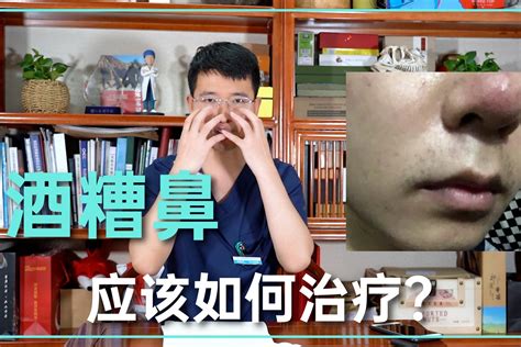 酒糟鼻应该如何治疗？对应的红斑期、丘疹脓疱期和鼻赘期怎样处理_凤凰网视频_凤凰网