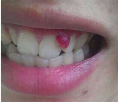 牙龈出现白脓包，你以为只是发炎吗？