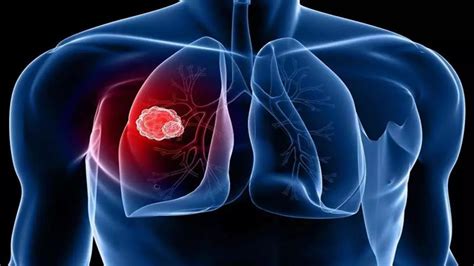 肺癌-病种分类-肿瘤治疗-自贡高新肿瘤医院有限公司