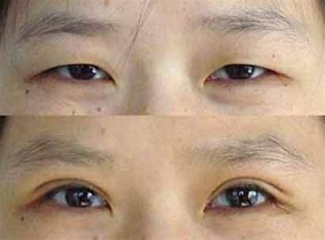 你见过的双眼皮手术最成功，效果最好的案例有哪些？ - 知乎