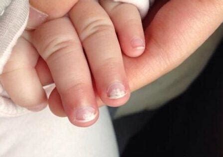 3岁女童手指甲莫名脱落，罪魁祸首原来是这种病，家长要当心！|手足口|手指甲|女童_新浪新闻