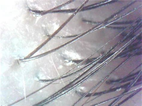 毛囊干细胞可以克隆毛囊？植发技术还能再进步吗？