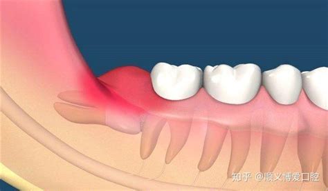 智齿发炎图片
