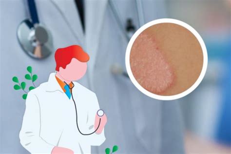 湿疹怎么可以治除根-中华银屑病网