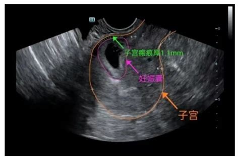 瘢痕子宫图片
