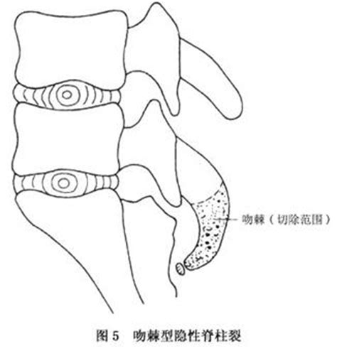 脊柱裂图片