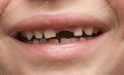 孩子门牙掉了什么时候能长出来 孩子门牙掉了急救处理方法 _八宝网
