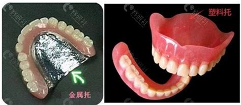 全口义齿的几种修理方法_基托_组织_塑料