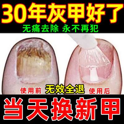 灰指甲特效药根治治疗亮甲正品专用药手指脚趾甲沟炎脱甲膏抑菌-淘宝网