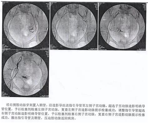 黄陂区中医医院实施多科联动诊疗模式 成功完成一例子宫动脉栓塞术应用瘢痕妊娠治疗