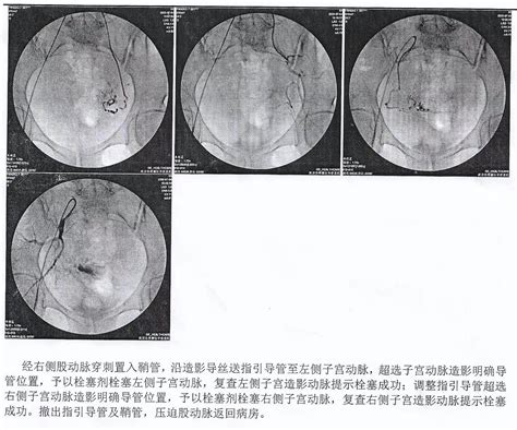 瘢痕子宫图片