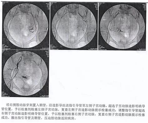 河源市人民医院网站-介入血管科成功开展子宫动脉栓塞术治疗子宫肌瘤