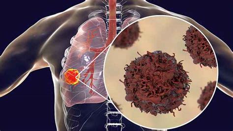 肺癌有以下5个征兆：