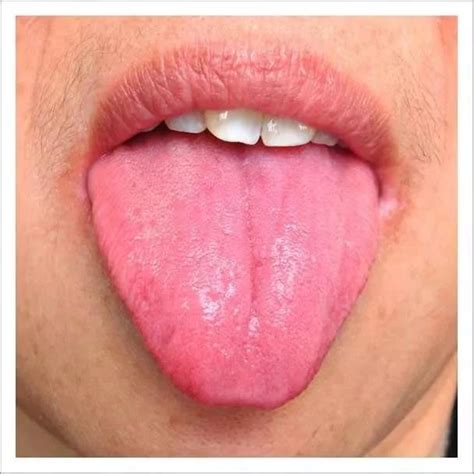 舌诊浅析：舌头有齿痕，舌面裂纹以及舌尖红点|舌头|裂纹|阴液_新浪新闻