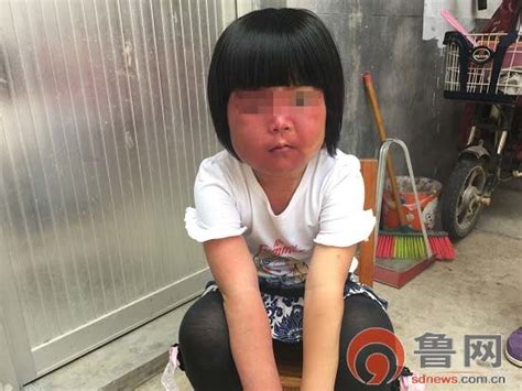 六岁女童患怪病 身体一半正常一半长红斑 - 民生关注 - 中国网 • 山东