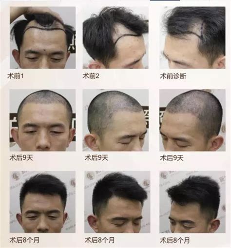 头发种植的步骤及术后注意事项_上海美莱医疗美容