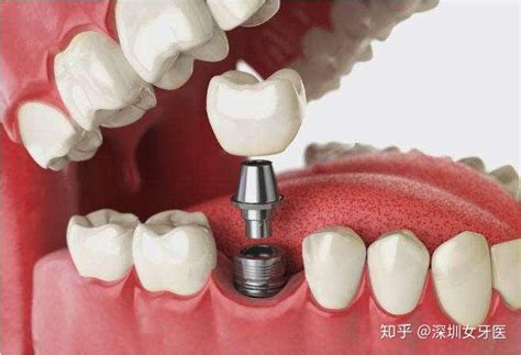 天津市口腔医院2023价格表更新，别吐槽单颗/半口全口种牙贵了 - 21怡口美牙网
