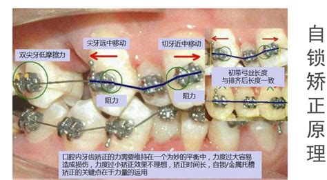 牙齿矫正过程动图图片