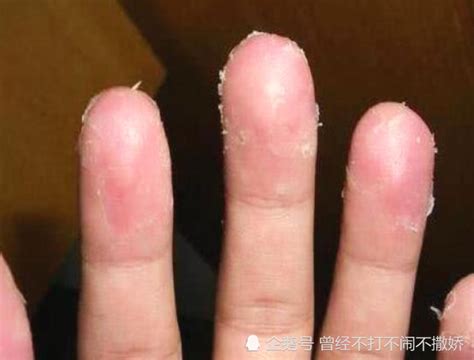 手指脱皮怎么回事？4种常见病因，帮你找到脱皮“真凶”！|手癣|脱皮|手指_新浪新闻